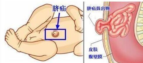 腹部疝气怎么治疗