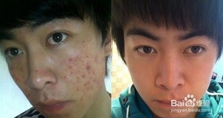 男孩青春期起痘痘