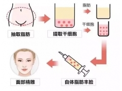 脂肪填充还是玻尿酸好