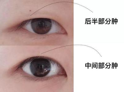 压 双眼皮