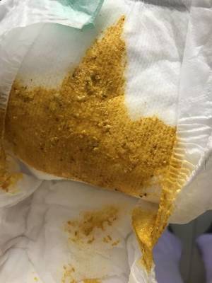 宝宝拉屎有黑色颗粒