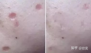 点痣留下的疤能消失吗