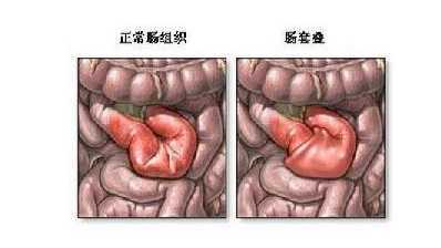 肠道淋巴结肿大是怎么回事