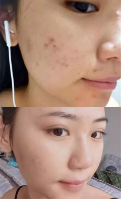 长痘痘去看皮肤科