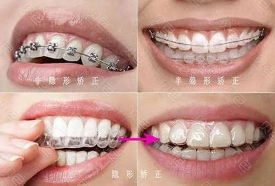 矫正牙齿隐形牙套价位