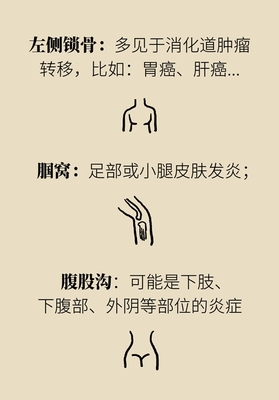 淋巴发炎是怎么回事
