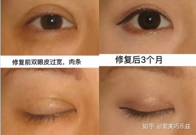 割完双眼皮恢复期