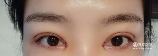 双眼皮切口处发红
