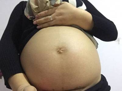 怀孕没有妊娠纹