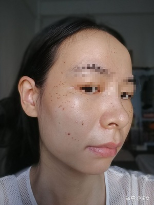 点痣以后怎么快速恢复