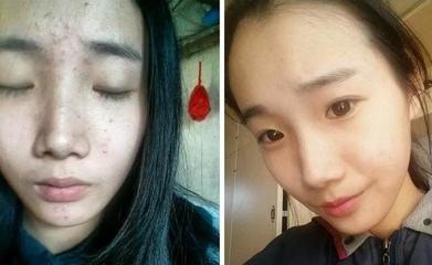 额头有痘痘是因为什么原因