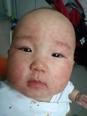 五个月宝宝出疹子怎么办