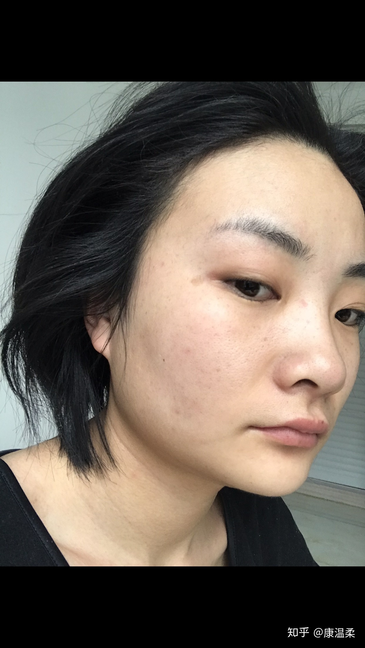 长痘痘闭口吃维生素b6