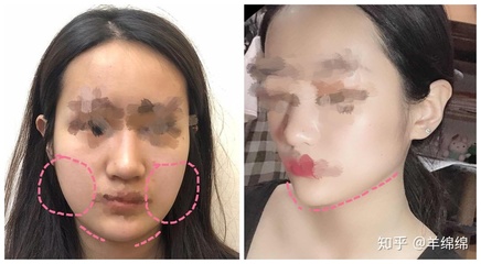 黄金微雕瘦脸