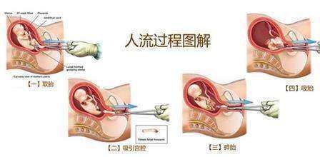怀孕药流过程
