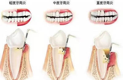 镶牙多久可以吃东西