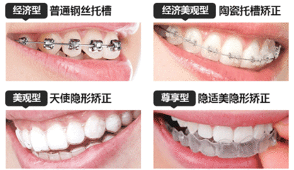 隐形牙齿柏德实惠