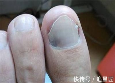 脚趾甲发白是怎么回事