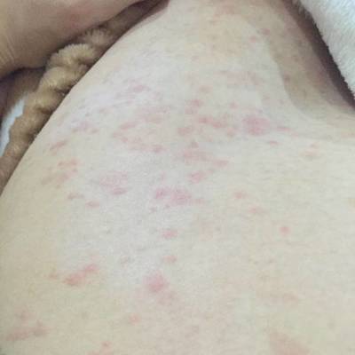 胆汁酸高怎么治疗