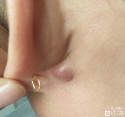 右耳朵后面疼是怎么回事