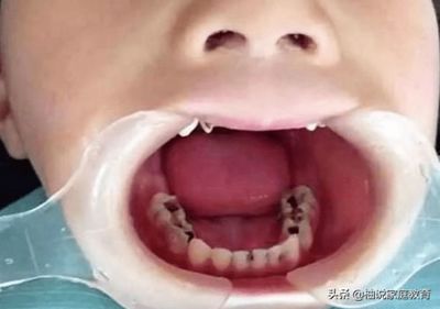 女人梦见自己拔掉牙齿