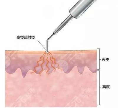 激光点痣几天可以碰水