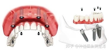 拔牙多久可以恢复