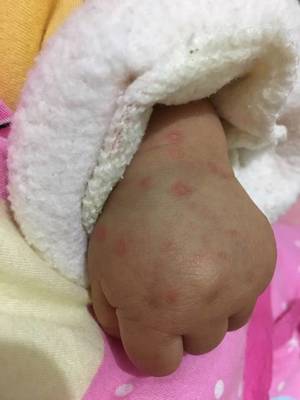 宝宝发烧后起疙瘩图片