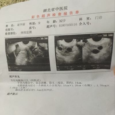 卵巢包块是怎么回事