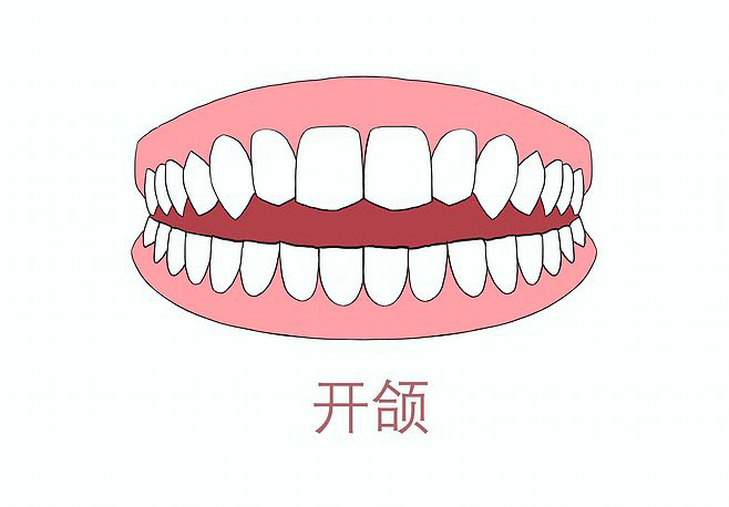 牙齿拥挤义齿和矫正