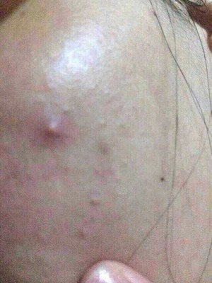 好多痘痘烦死了