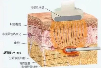 抽脂融脂