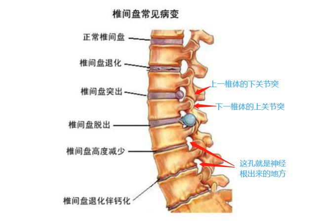 腰间盘突出压迫神经怎么治疗