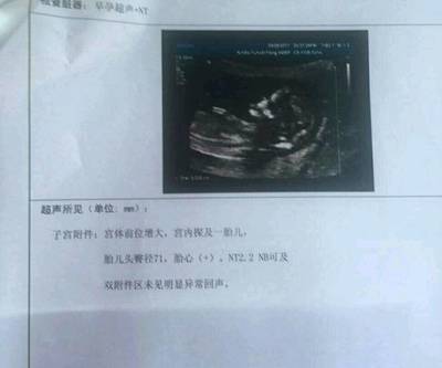 怀孕12周胎儿会动吗
