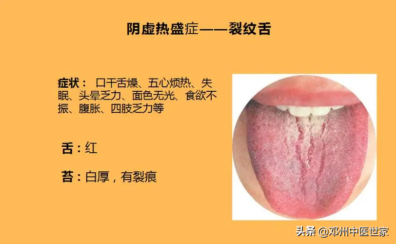 舌尖裂纹是怎么回事
