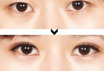 桃花眼必须是双眼皮吗