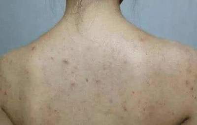 后背冒痘痘什么原因