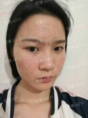 祛痘痘痘印的app软件