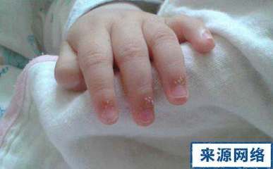 宝宝指甲上有白点是什么原因
