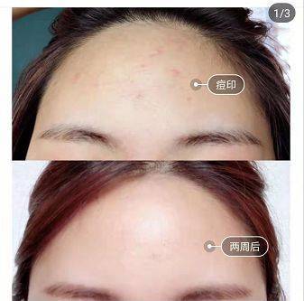 痘印变黑了还能好吗