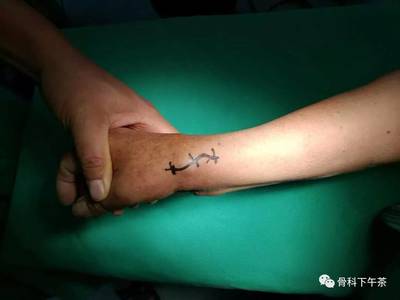 手指关节腱鞘囊肿怎么治疗