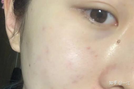 出油痘痘痘印面膜
