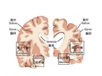 大脑萎缩是怎么回事