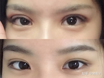 割了双眼皮需要注意事项