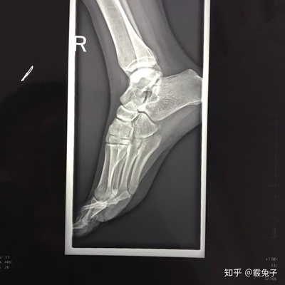 副舟骨怎么治疗最好