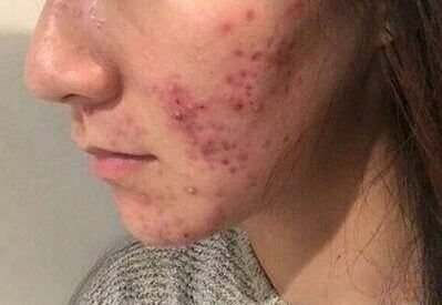 痘痘白白的要不要挤掉