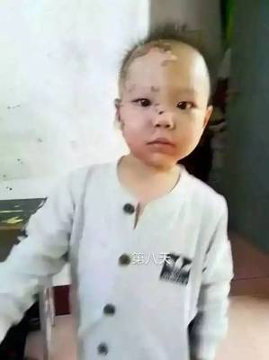 小孩烫伤疤痕怎么办
