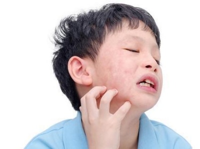 小孩的湿疹怎么治疗最好方法