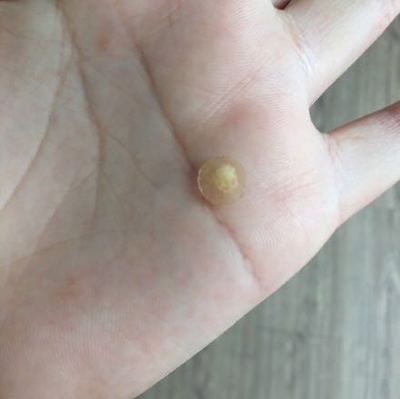 3m痘痘贴贴多久