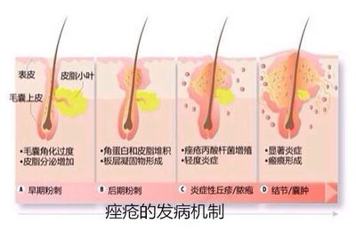 痘痘和粉刺怎么区分